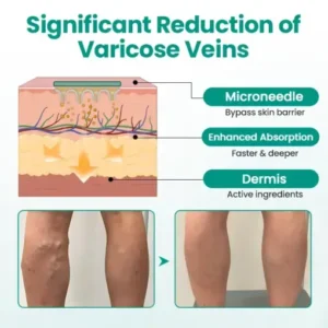 Timilk® LegRenew Varicose Veins Patch
