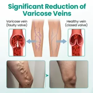 Timilk® LegRenew Varicose Veins Patch